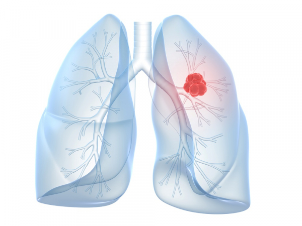 Akciğer Kanseri Yayılmadan Önce Yıllarca Saklı Kalabiliyor