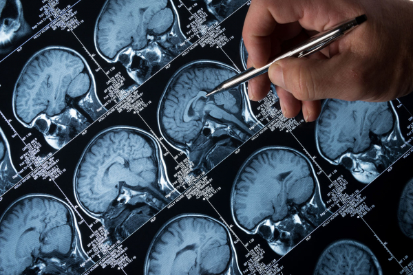 Epilepsi Hastaları İçin Beyin İmplantı