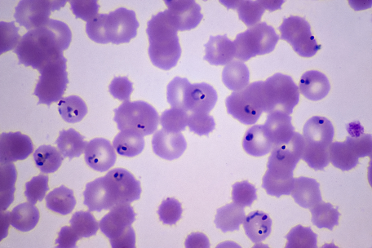 Kırmızı kan hücrelerindeki Plasmodium falciparum (koyu mor renkte)