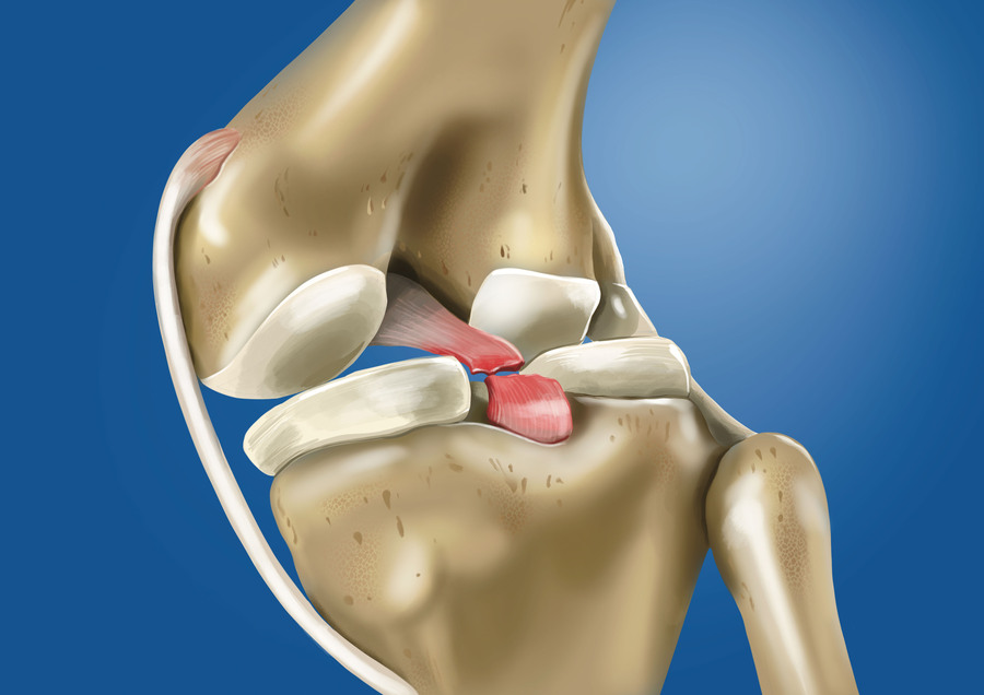 menisküs yırtığı