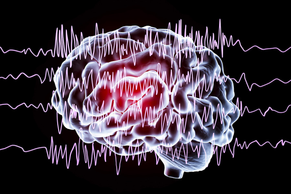 Epilepsi Nöbetleri Tahmin Edilebiliyor